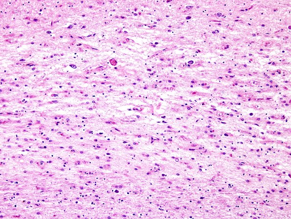 4A7 Argyrophilic Grain Dz & HC Sclerosis (Case 4) L5 H&E 6.jpg