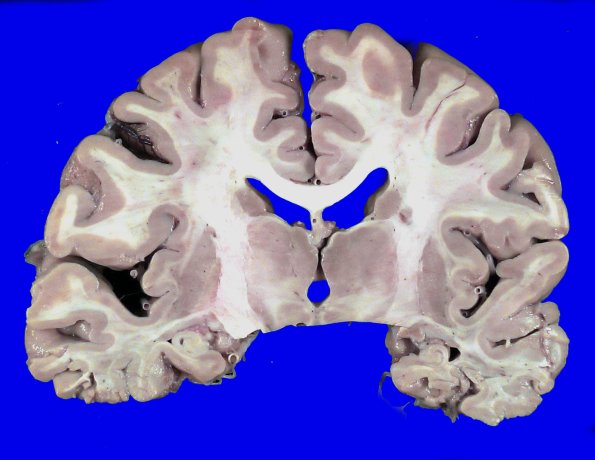 5A1 HScl (Case 5) Gross_1