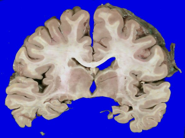 5A2 HScl (Case 5) Gross_2