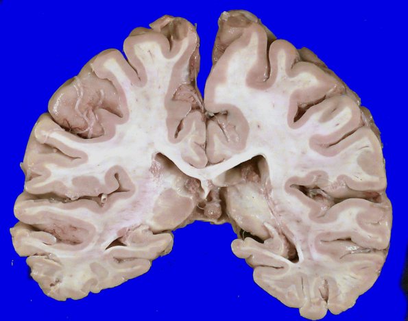 5A3 HScl (Case 5) Gross_3