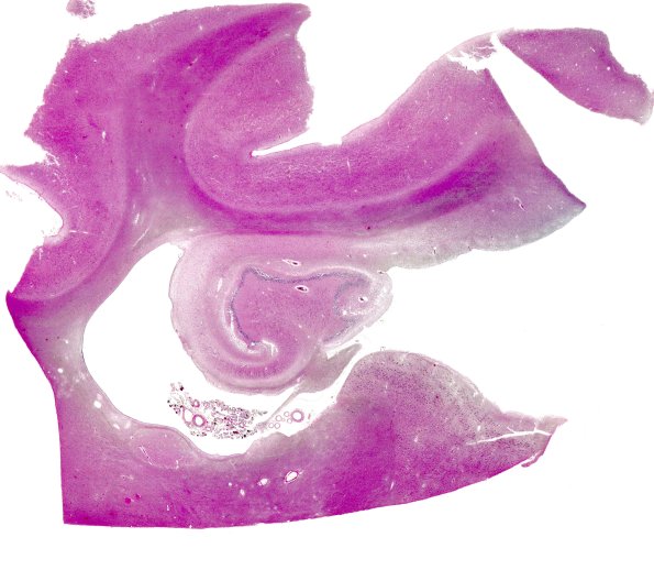 5B1 Hippocampal Sclerosis (Case 5) N11 H&E whole mount