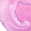 5B2 Hippocampal Sclerosis (Case 5) N11 H&E 5.jpg