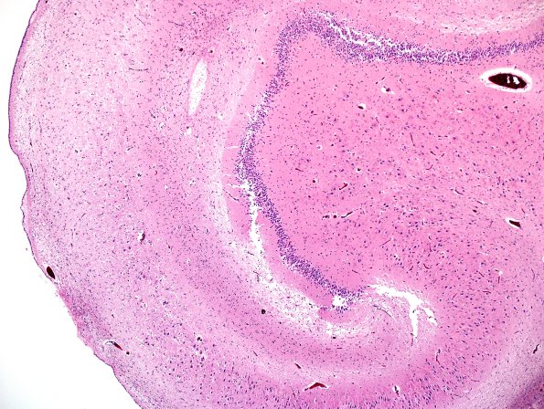 5B2 Hippocampal Sclerosis (Case 5) N11 H&E 5.jpg