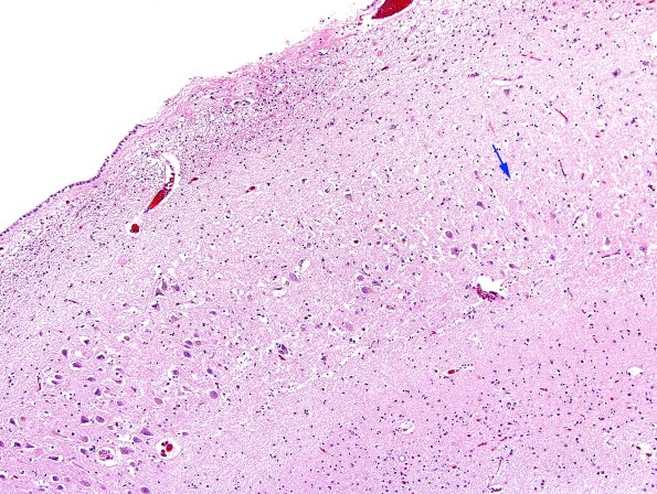 5B3 Hippocampal Sclerosis (Case 5) N11 H&E 3 copy.jpg