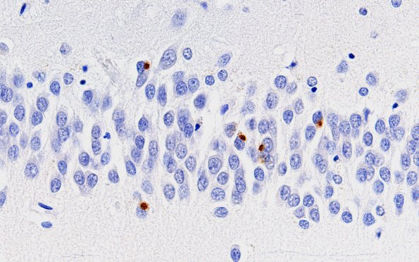 5C1 Hippocampal Sclerosis (Case 5) N3 TDP43 60X