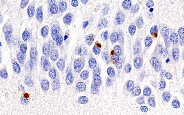 5C2 Hippocampal Sclerosis (Case 5) N3 TDP43 100X