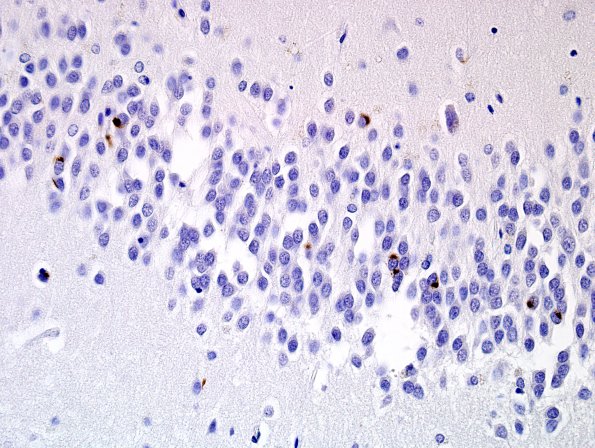 5C3 Hippocampal Sclerosis (Case 5) N11 TDP43 1.jpg