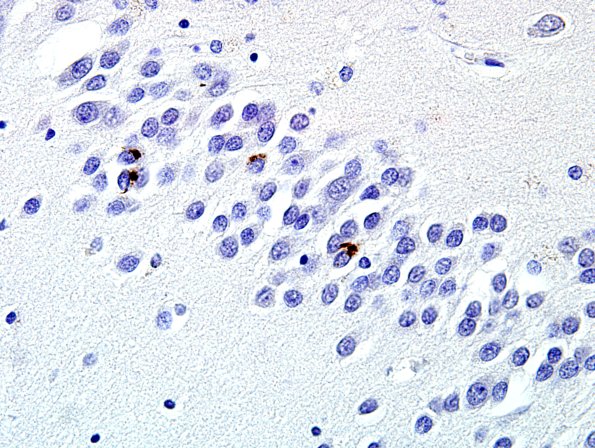 5C4 Hippocampal Sclerosis (Case 5) N11 TDP43 7.jpg