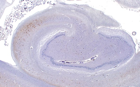 5D1 Hippocampal Sclerosis (Case 5) N3 PHF 2X