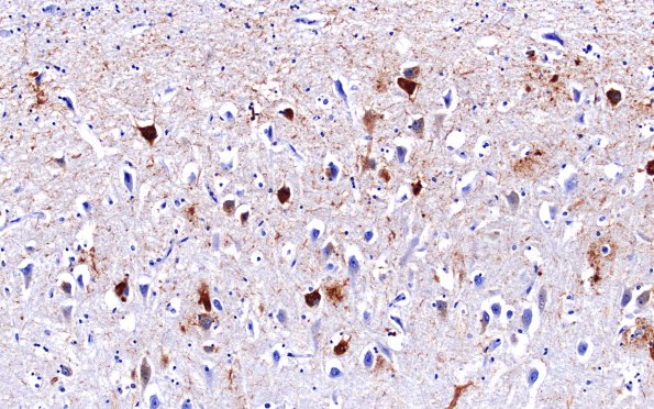 5D2 Hippocampal Sclerosis (Case 5) N3 PHF 20X