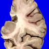 6A1 Hippocampal sclerosis (Case 6)_1