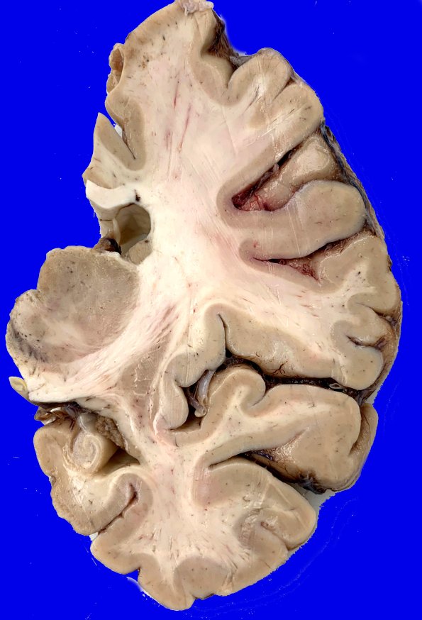 6A1 Hippocampal sclerosis (Case 6)_1