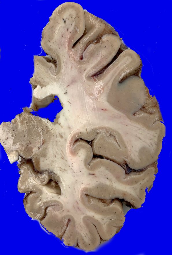 6A3 HScl (Case 6) Gross_1