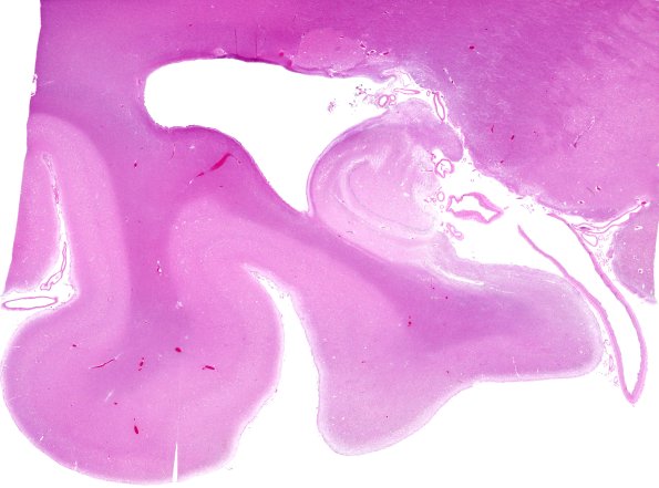 6B1 Hippocampal sclerosis (Case 6) N3 H&E WM