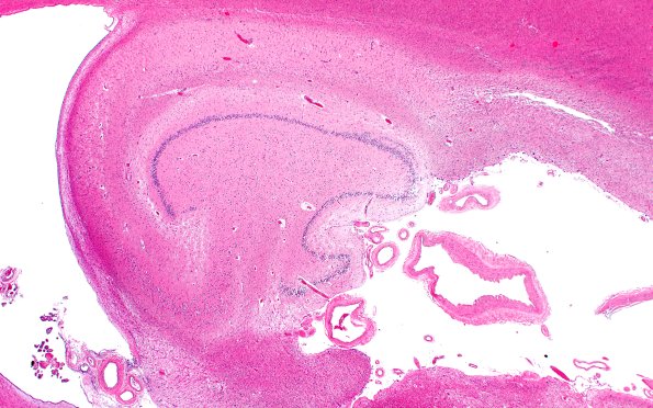 6B2 Hippocampal sclerosis (Case 6) N3 H&E 2X