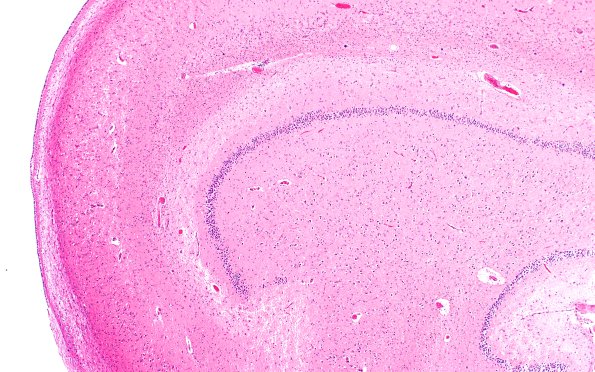 6B3 Hippocampal sclerosis (Case 6) N3 H&E 2