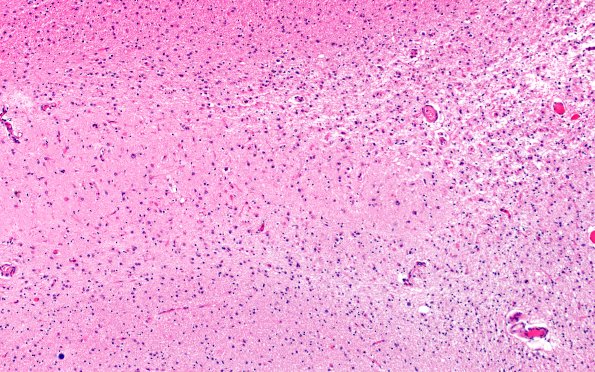 6B4 Hippocampal sclerosis (Case 6) N3 CA1 H&E 1