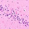 6B5 Hippocampal sclerosis (Case 6) N3 H&E 1