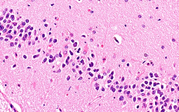 6B5 Hippocampal sclerosis (Case 6) N3 H&E 1