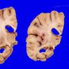 7A1 Hippocampal sclerosis without AD (Case 7)