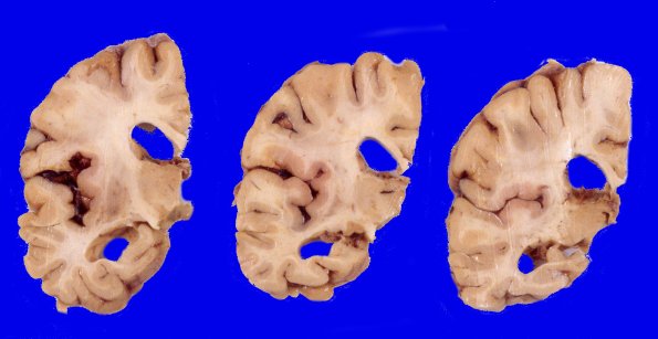 7A1 Hippocampal sclerosis without AD (Case 7)