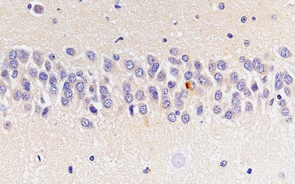 7C2 HS no AD (Case 7) TDP43 60X