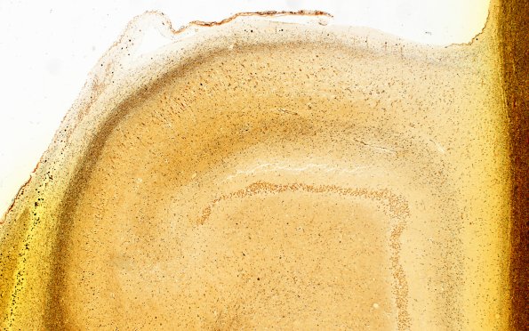 7D HS no AD (Case 7) MBT 4X