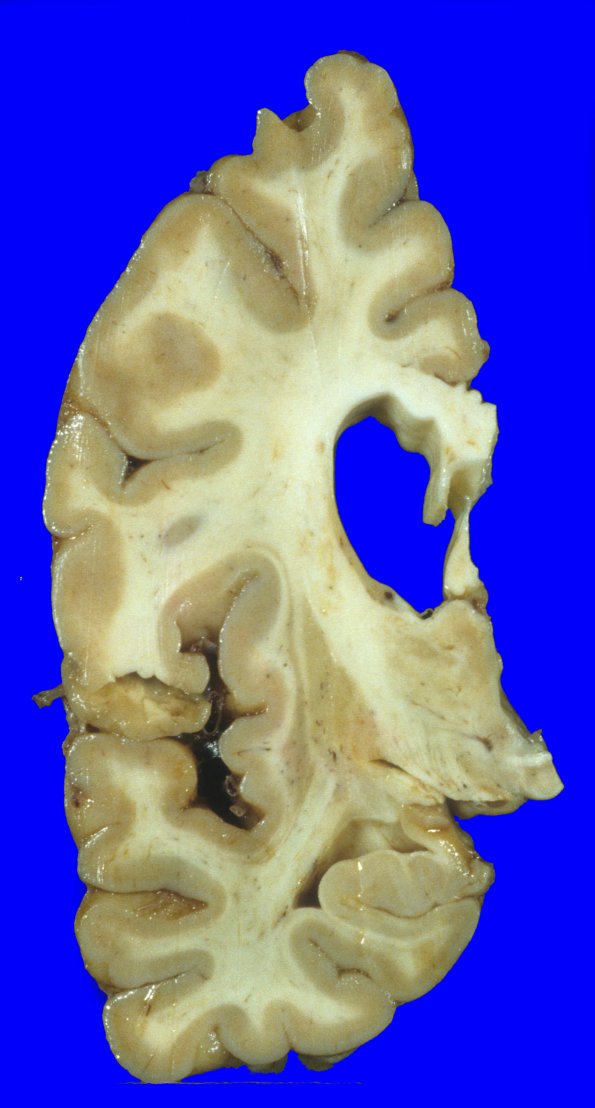 11A1 Huntington Dz (Case 11) 1