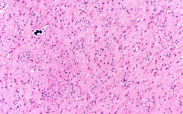 11B2 Huntington Dz (Case 11) H&E 20X