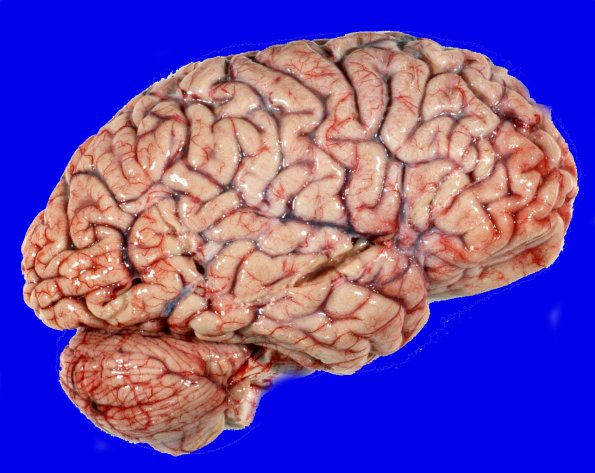 13A1 Huntington's Disease (Case 13) gross_2