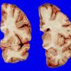 13A2 Huntington's Disease (Case 13) gross_4