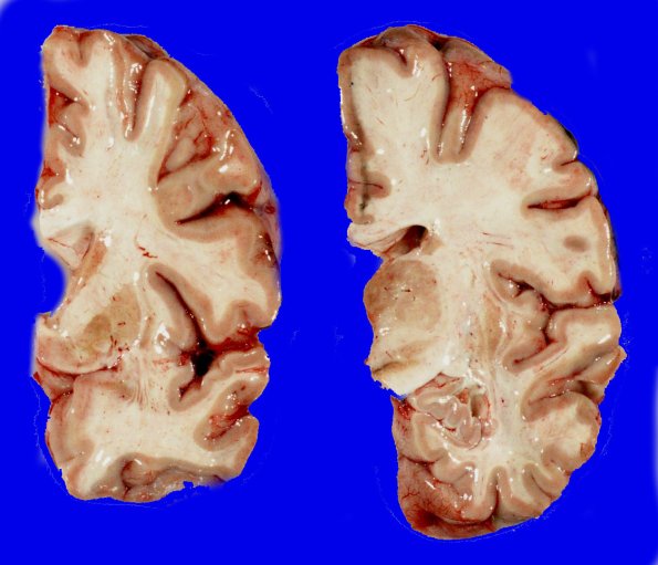 13A2 Huntington's Disease (Case 13) gross_4