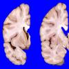 13A3 Huntington's Disease (Case 13) gross_7