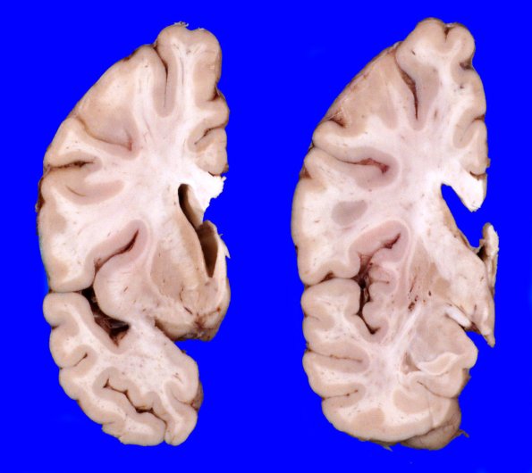 13A3 Huntington's Disease (Case 13) gross_7