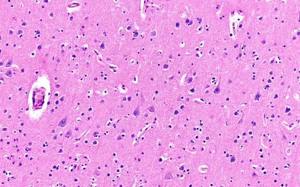 13B2 Huntington's Disease (Case 13) L1 H&E 20X 2