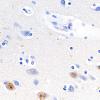 13C1 Huntington's Disease (Case 13) L1 1C2 60X