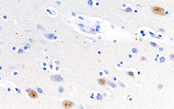 13C1 Huntington's Disease (Case 13) L1 1C2 60X