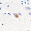 13C2 Huntington's Disease (Case 13) L1 1C2 100X