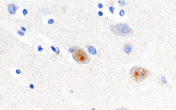 13C2 Huntington's Disease (Case 13) L1 1C2 100X