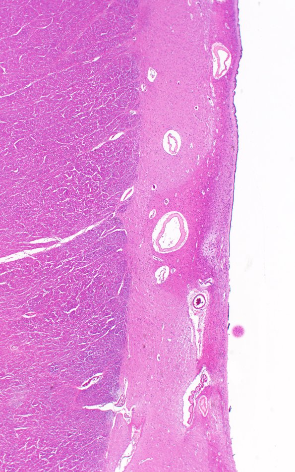 13D2 Huntington's Disease (Case 13) L17 H&E 2X 2