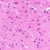 13D3 Huntington's Disease (Case 13) L17 H&E 40X