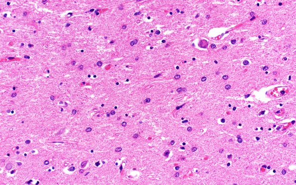 13D3 Huntington's Disease (Case 13) L17 H&E 40X