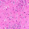 13D4 Huntington's Disease (Case 13) L6 H&E 40X 2