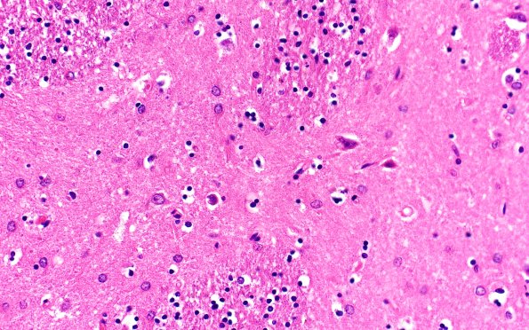 13D4 Huntington's Disease (Case 13) L6 H&E 40X 2