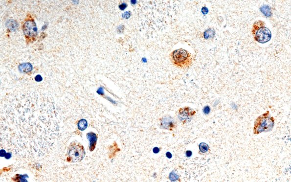 13E Huntington's Disease (Case 13) L6 1C2 100X 3