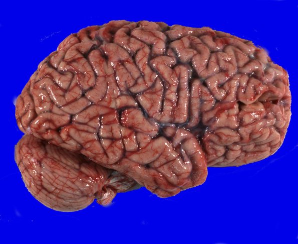 14A1 Huntington's Disease (Case 14) Gross_2