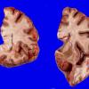 14A2 Huntington's Disease (Case 14) Gross_3