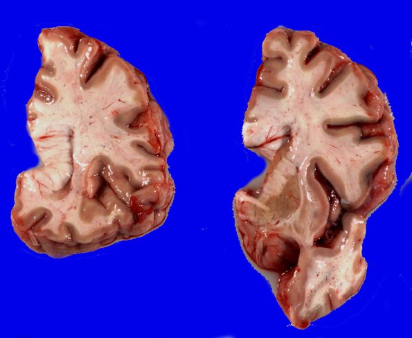 14A2 Huntington's Disease (Case 14) Gross_3