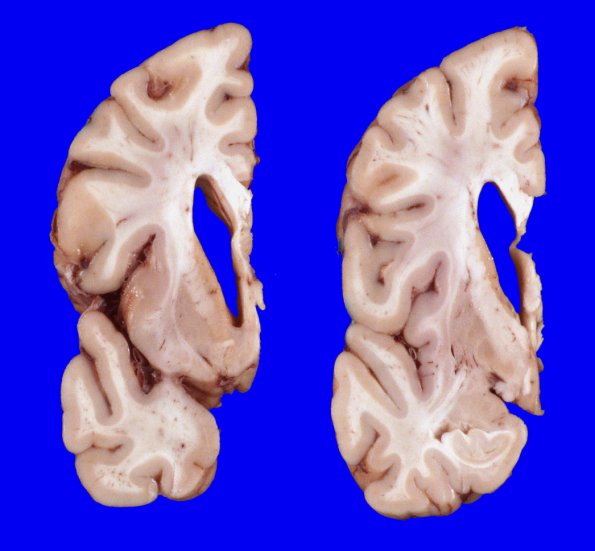 14A3 Huntington's Disease (Case 14) Gross_7