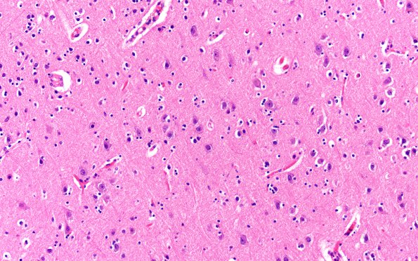 14B Huntington's Disease (Case 14) L1 20X